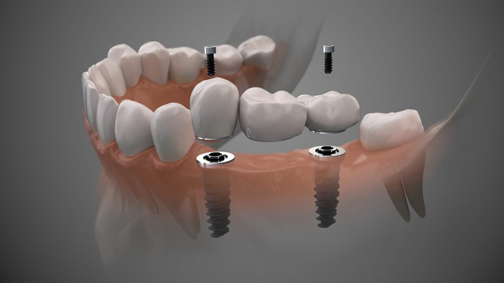 Teljes fogsor implantátum és fogkő eltávolítás otthon